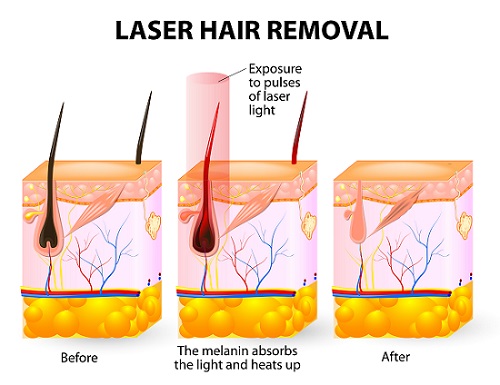 Laser hair removal. Vector diagram - Paradise Med Spa